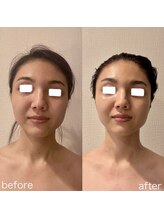 エミナル(EMINALu)/左右差・頬骨・くいしばり