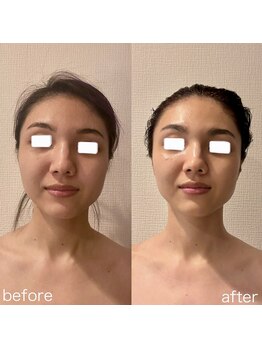 エミナル(EMINALu)/左右差・頬骨・くいしばり