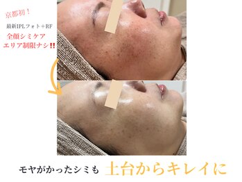 エソア(esoa)/40代 光フォト8回施行