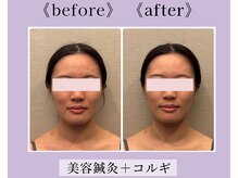 リソラ(RESORA)/美容鍼灸とコルギで速攻小顔