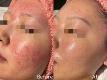 ビューティーサロンリア 栄 伏見店(LI'A)の雰囲気(全9シリーズからお肌に合ったピーリングが選べる◎)