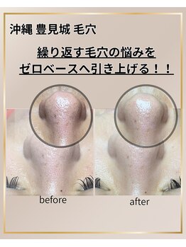 ハルハル(Haru Haru)/毛穴の悩み