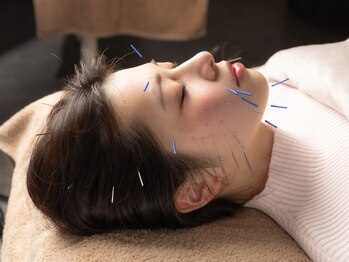 ハリヤベース鍼灸整骨院(HaRiYa BaSe鍼灸整骨院)の写真/HaRiYa BaSeだけの美容鍼体験で憧れの陶器肌＆スッキリ小顔へ≪美容鍼×超音波40分￥5980≫