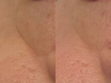 ベアール(beal)/艶美肌ハーブピーリング2回