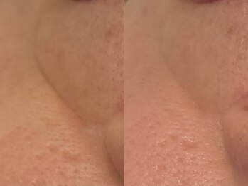 ベアール(beal)/艶美肌ハーブピーリング2回