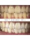 コガオファクトリー 旭川院(KOGAO FACTORY)の写真/今までのホワイトニングで満足できなかった方へ！最新型マシンの圧倒的パワーで輝く白さに。