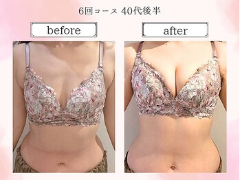 リール 恵比寿店(RIRE)/バストアップ症例【広尾恵比寿】