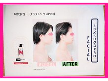 フレクシー/４D　beforeafter