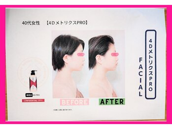 フレクシー/４D　beforeafter