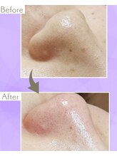 サロン モウ(mou。)/毛穴黒ずみ