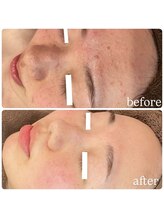 ラディエンス 多治見店/リアボーテ毛穴ケアエステ