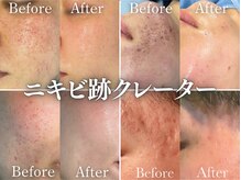 ブレア(Blair)の雰囲気（肌悩みにあった施術をご案内☆継続で肌質改善へ）