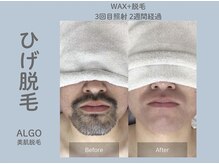 アルゴ 高槻店(ALGO)の雰囲気（『朝の自己処理から解放された』と大好評のメンズヒゲ脱毛♪）