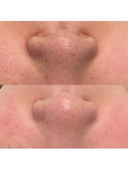 ミューズ(MUSE)/エクストラクション＋白玉ピコ