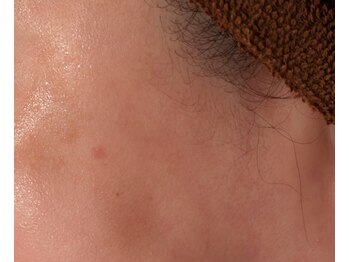 サロンドカイ(Salon de Kai)/カーボンフェイシャル 1回