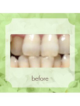 ビューティフィーサロン ベルル(Belulu)/セルフホワイトニングお手入れ前