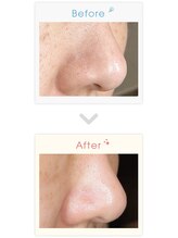 レリア(Reria)/毛穴洗浄