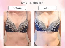 リール 恵比寿店(RIRE)/バストアップ症例【広尾恵比寿】