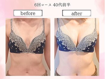 リール 恵比寿店(RIRE)/バストアップ症例【広尾恵比寿】