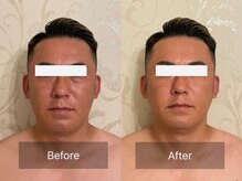 エーアイビューティー 御徒町店(Ai Beauty)/ 【フェイシャル例】