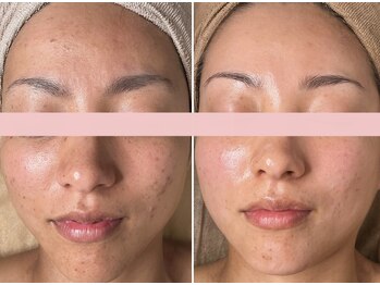 エイプリルフールズ(April fools)/【30代】ニキビ/凹凸改善