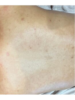 リベル 名古屋(Lebelle:)/ハーブピーリング専門名古屋