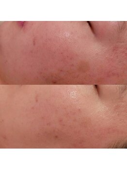 サロン ソワイユ(salon soyeux)/ハリツヤup！気になるシミも薄く