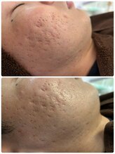 サロン ド グランツィア(salon de Granzia)/20代☆ニキビ改善ケア