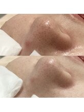 アミュレット(amulette)/毛穴のお悩み解消！！