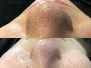 グレイティア(gratia)/鼻の黒ずみ改善!ハイドロ!