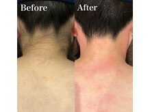 ジョエルワックス 沖縄那覇店(JOELLE WAX)/夏に向けてうなじ、背中ケア！