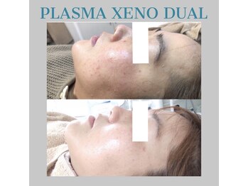 ビーダブリュー(BW...)/☆プラズマゼノデュアル施術例☆