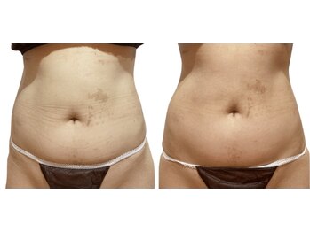 痩せラボ/くびれ作り【痩身】