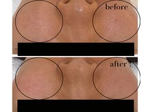 アイチューズ(ICHOOSE)/驚きのVC誘導体ケア！