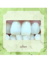 ビューティフィーサロン ベルル(Belulu)/セルフホワイトニング５回後