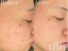 ライム 札幌(LIME)/ハーブピーリング|ニキビケア