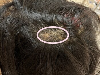 表参道ビオ東洋医学センター/円脱のお悩みに鍼灸マッサージ◎