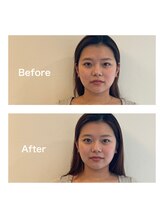 ヤマノ(YAMANO)/ベーシック美容鍼