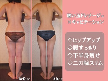 エステティックサロンティエリー/吸い玉×キャビ×ドレナージュ