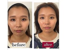 サロンチオリ 烏丸(Salon Chiori)/《30代》むくみとエラ張り矯正