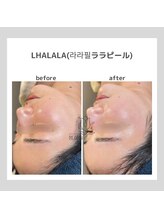 韓国肌管理室pom.haneul【ポムハヌル】LDM/インモード/ララピール/プラピール福岡天神/韓国肌管理室