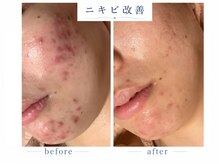 シャルナ(charna)の雰囲気（ニキビ、跡ケア　改善しない症状はありません）