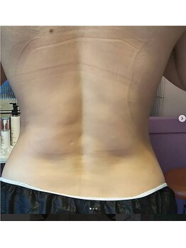 エステティック パルフェ/ダウンタイムのインディバケア◎