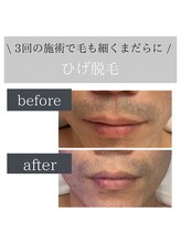 ロカヒ(Lokahi)/ひげ脱毛3回目 毛も細くまだらに