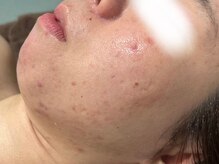 アンドユー ヨコハマ(&U Yokohama)/クリスティーナ施術1回後