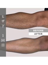 アイリビューティー専科(AIRIビューティー専科)/メンズ脱毛：ひざ下脱毛