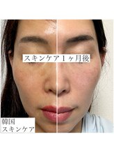 レイ(Rey)/オーダーメイド肌質改善