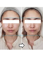 きしの美容整体院/フェイシャルリフトケアBA