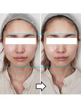 きしの美容整体院/フェイシャルリフトケアBA