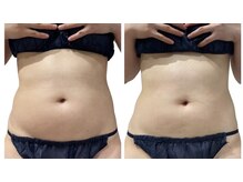 痩せラボ/お腹スッキリ【痩身】